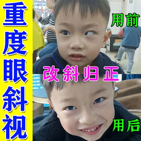 幼兒斜眼看人|幼 兒 斜 弱 視